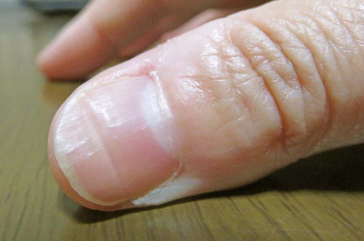 爪の悩み解消 意外と知らないトラブルの原因と対処法とは Fumumu